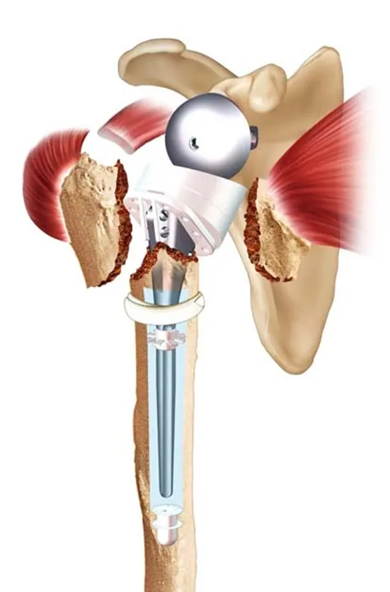 proth-inv-fracture-reconst-tub