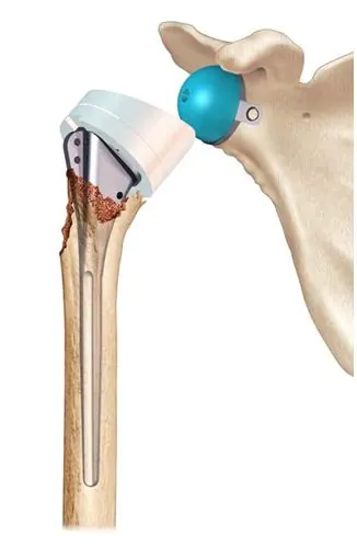 proth-inv-fracture-sans-reconst-tub