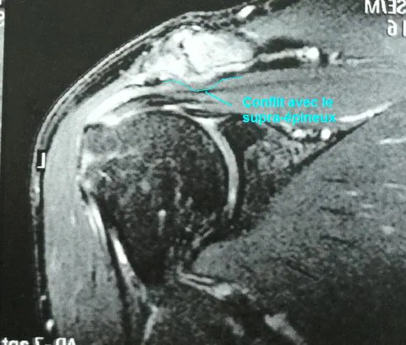 arthrose AC face commentée IRM