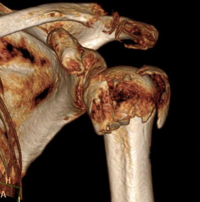 Ostéosynthèse de l'humerus - epaule Toulouse