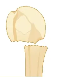 fract-col-chir