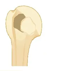 fract-tuber-mineur