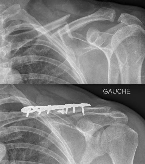 les fractures de la clavicule - epaule Toulouse