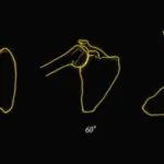scapulothoracique-4