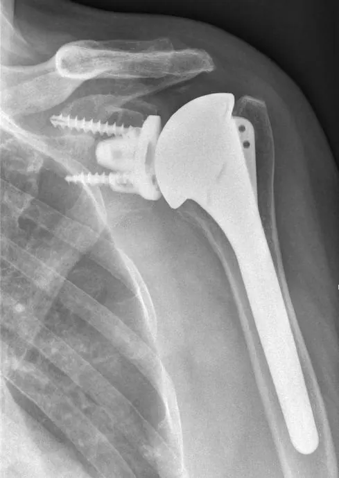 PTE-anat-Levade-metalback1