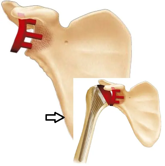 essai-glene-PE1