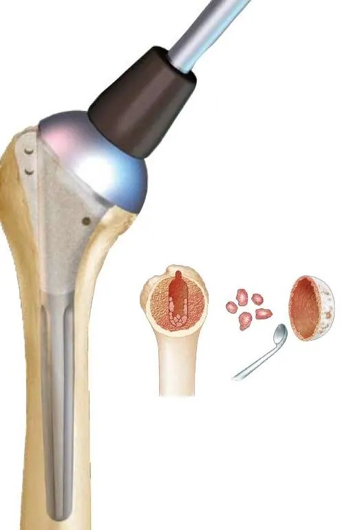 impaction-tige-et-tete-definitives-2