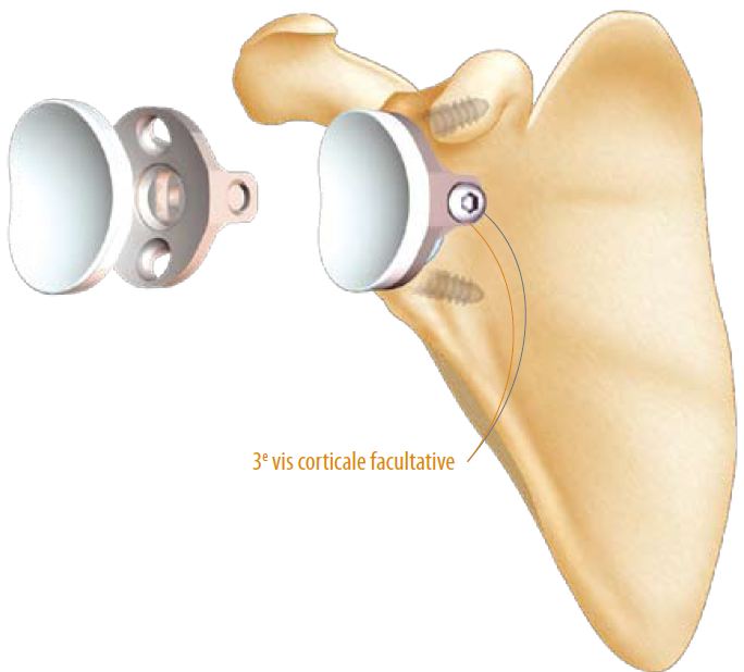 montage-metal-back-définitif