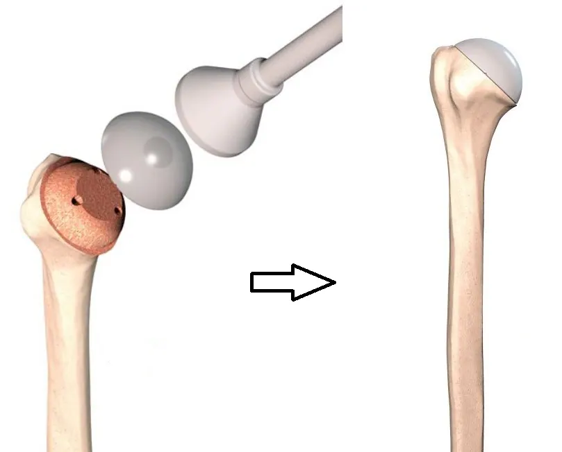 resurf-impaction-et-aspect-final