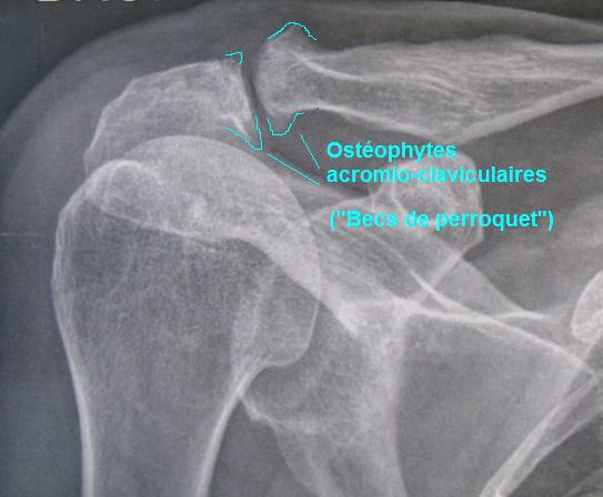 arthrose AC radio copie